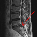 ¿Necesito cirugía de hernia discal?