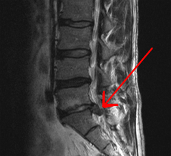 ¿Necesito cirugía de hernia discal?
