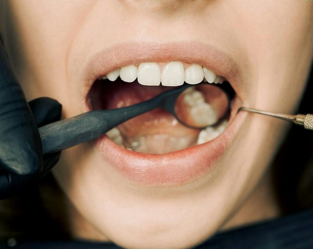 Limpieza dental profesional, beneficios y cuidados