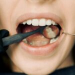Limpieza dental profesional, beneficios y cuidados