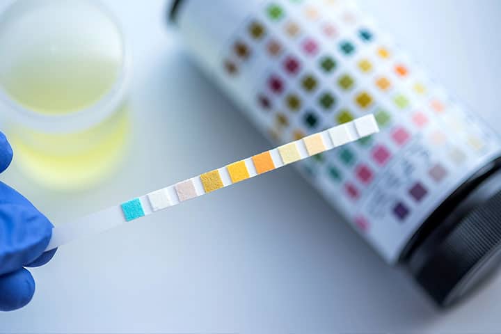 Proteína en la orina, causas y diagnóstico